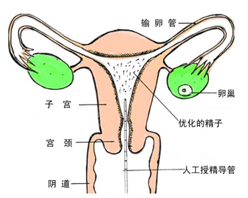 人工受精知识专题_人工受精的过程_人工受精的费用