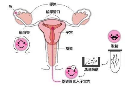 人工受孕知识专题_人工受孕流程_人工受孕方法