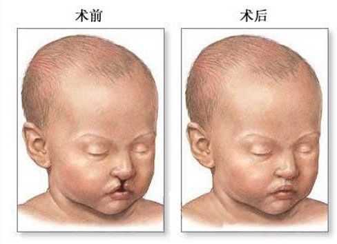 造成婴儿兔唇的原因解析 唇裂的预防关键在于怀