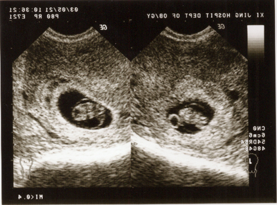 教你看怀孕9周b超图 细看宝宝“照片”透露的信(2)