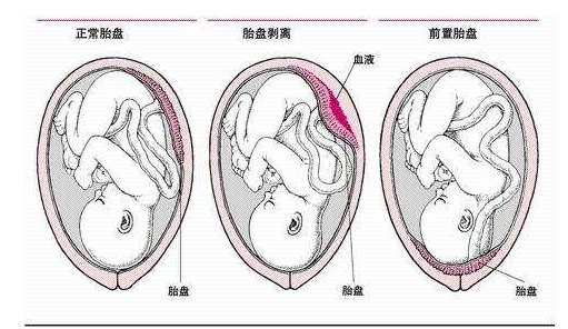 前壁胎盘是什么意思 和后壁的区别