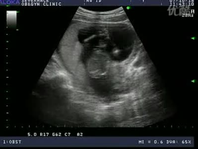 怀孕12周胚芽大小正常值 胚胎停止发育的症状(2)