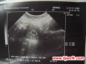 怀孕12周胚芽大小正常值 胚胎停止发育的症状(3)