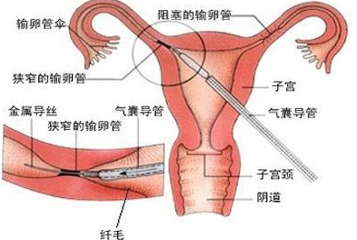 子宫后位怎么变成前位 怎么睡觉正确