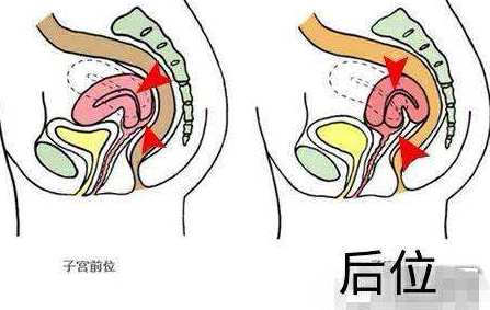 子宫后位怎么变成前位 怎么睡觉正确